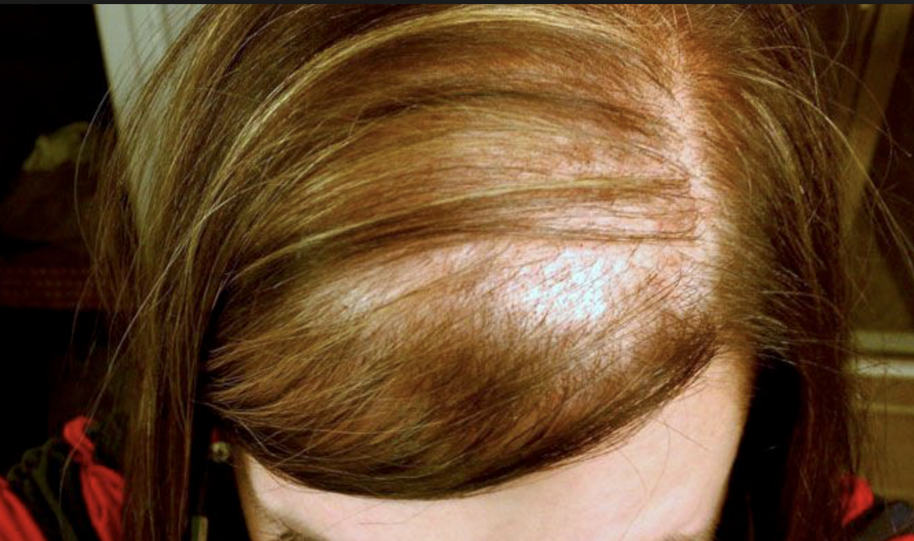 Red & near IR Light Therapy for Alopecia and Hair Loss - Giedre Holistic  Therapies